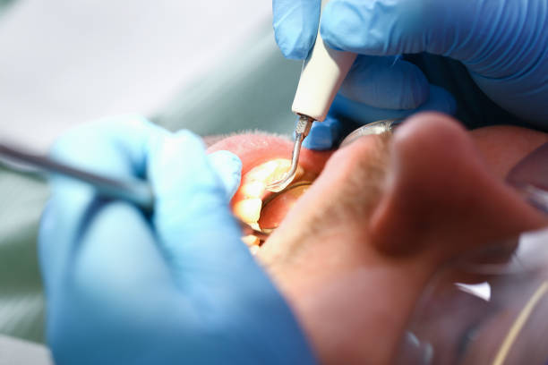 Best Emergency Wisdom Teeth Removal in Ellinwood, KS