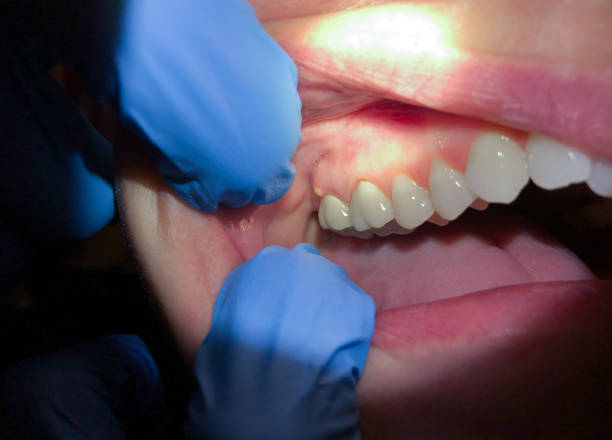 Best Emergency Gum Treatment in Ellinwood, KS
